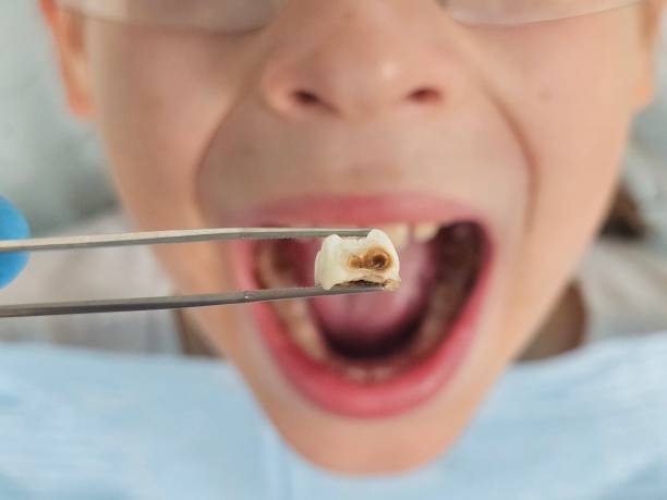 Best Emergency Treatment for Toothache in Ringgold, LA
